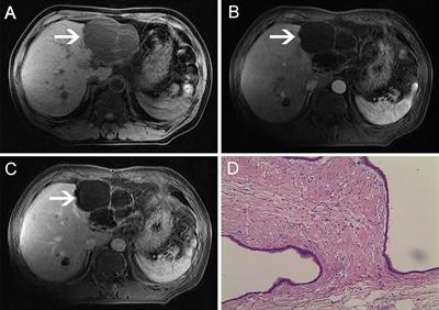 Case Report: Low-Dose Apatinib in the Treatment of Intrahepatic Biliary Cystadenoma With Recurrence and Malignant Transformation